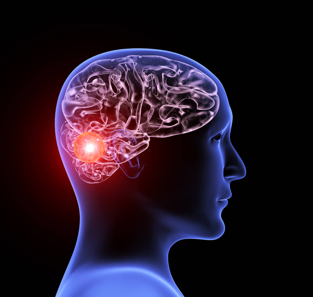 跨文化适应性和测量属性分析巴西葡萄牙语版本的Migraine Interictal Burden Scale-4。