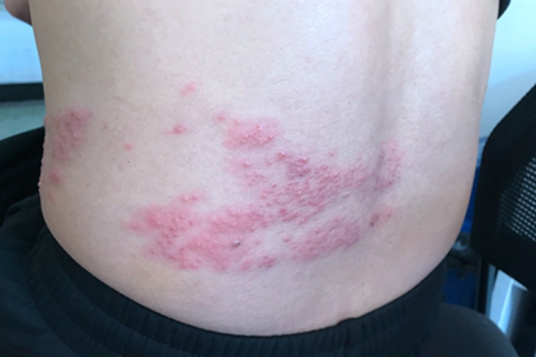 Belt cirrhosis is the body's immune resp