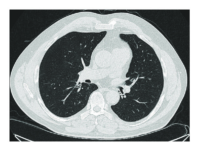 基于有氧肺部疾病（如慢性阻塞性肺疾病（COPD）和肺部肿块（肺结节））和肺部肿块（肺结节））的分类分析，机器学习集成免疫