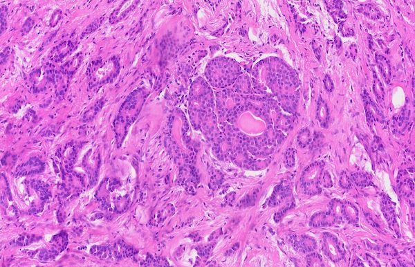 乳腺癌中EIF4EBP1的翻译控制、调控网络和治疗前沿领域。