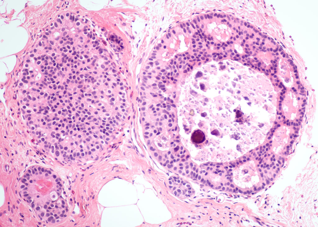 在涎腺癌中，perineural invasion的预测价值：一项比较性meta分析。