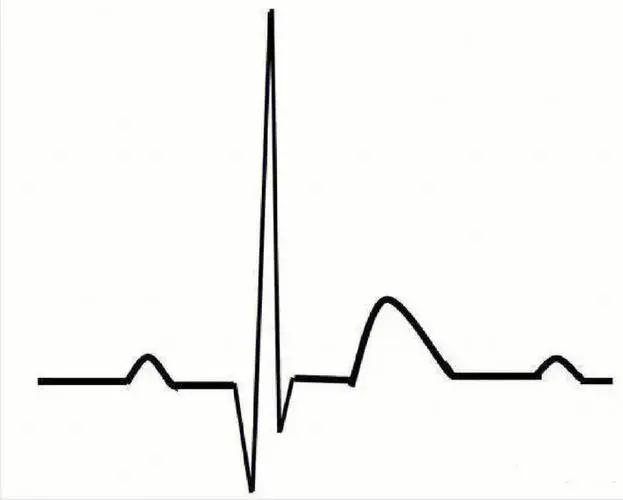 预后指标(SII)、内皮生长因子(NLR)和肌酐(creatinine)在术后住院时间及临床结局中对患者进行单源动脉内皮