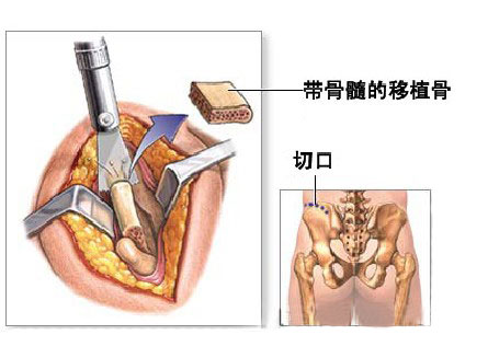 骨头可以存进 "骨银行"?这项新技术让 "医疗废物" 变